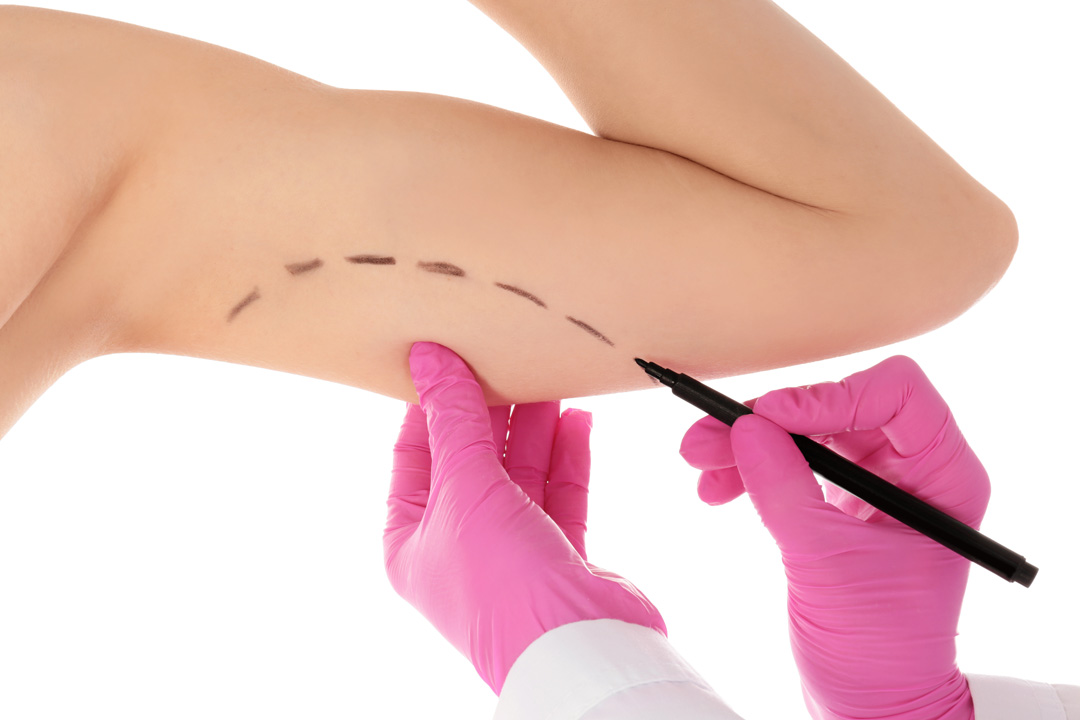 Doctor drawing marks on woman's arm against white background. Cosmetic surgery. Arm Lift Toronto.